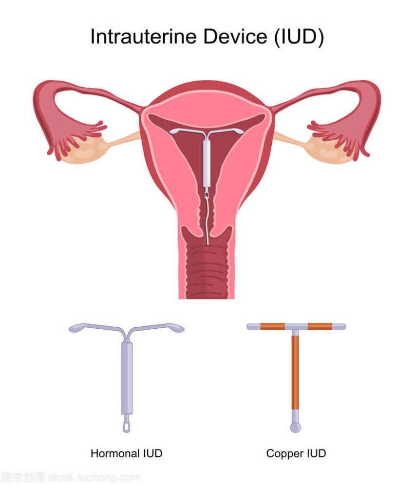 女人节育器图片图片